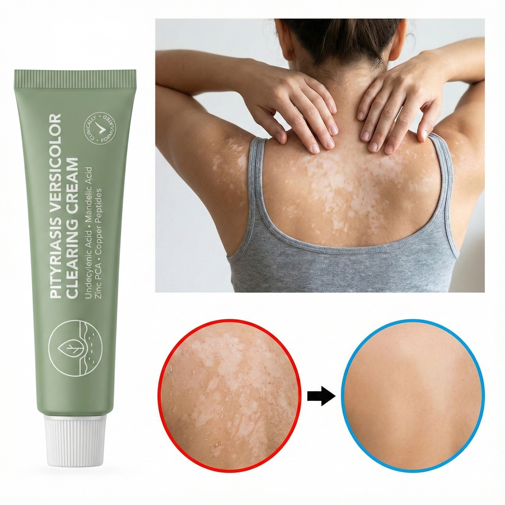 3x Pityriasis Versicolor Clearing Cream